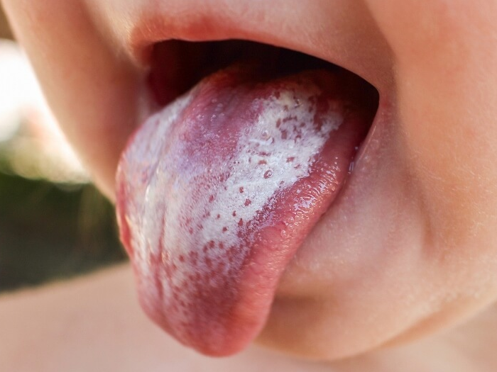 Диагностика и лечение налёта на языке у ребёнка 