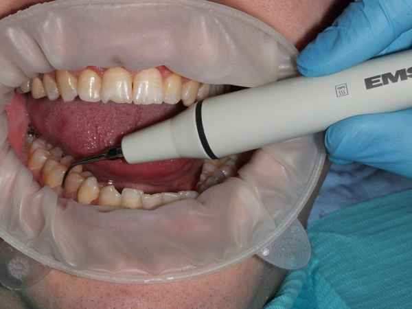 Болезни зубов: устранение зубного камня, ключевые методы лечения| 