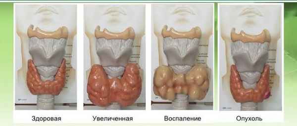 Патология щитовидной железы 
