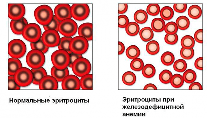 Железодефицитная анемия: причины, симптомы, лечение| 