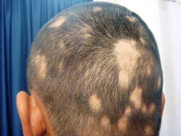 Факторы, которые могут стать причинами преждевременного выпадения волос| 