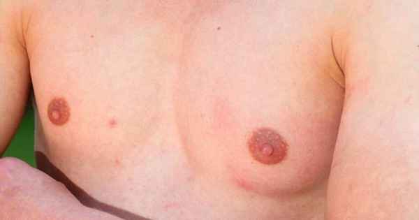 Гинекомастия: не мужественная грудь| 