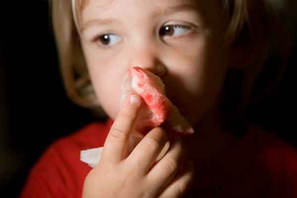 Что делать при носовых кровотечениях: причины и лечение| 