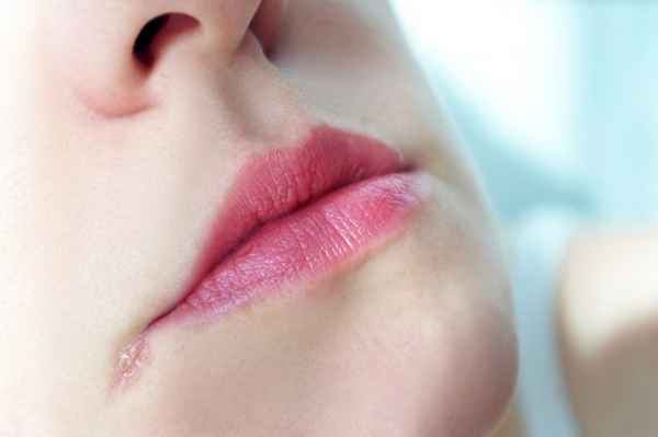 Почему трескаются губы в уголках: обстоятельства появления 