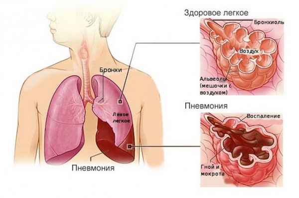 Воспаление лёгких, лечение в домашних условиях 