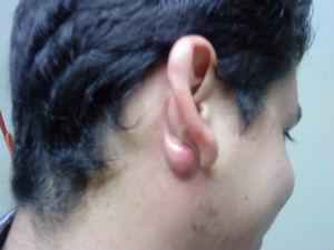 Атерома уха: причины появление на мочке, симптомы, лечение
