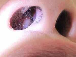 Полипоз носа: симптомы, что это такое, лечение и диагностика