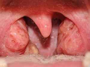 Паратонзиллит: лечение, симптомы паратонзиллярного абсцесса горла