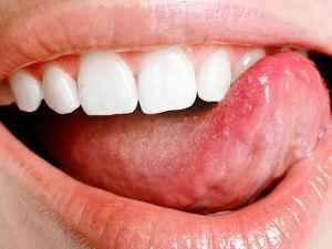 Заболевания слизистой оболочки полости рта у взрослых, стоматологические болезни