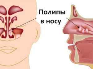 Полипы в носу: симптомы и лечение, что это такое, как лечить, причины