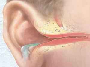 Воспаление среднего уха: симптомы, лечение, в т