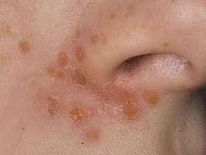 Золотистый стафилококк в носу: лечение, как лечить у взрослых и детей, симптомы