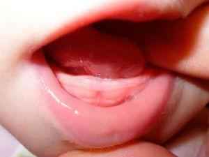 У ребенка красное горло: лечение, чем полоскать, причины температуры