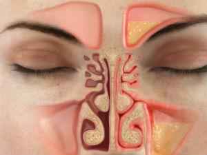 Пневматизация пазух носа: что это такое, почему они бывают пневматизированы