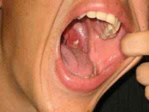 Белый налет в горле (слизь, гнойники): причины образования и лечение