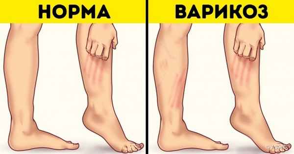 6 неочевидных признаков варикозной болезни ног
