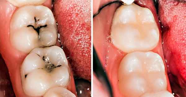 8 простых способов избавиться от кариеса и дыр в зубах естественным путем