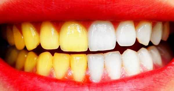 9 трюков, чтобы отбелить зубы не выходя из дома